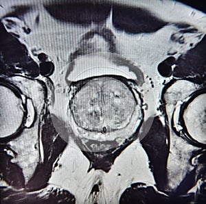 Ca prostate mri exam diagnostic