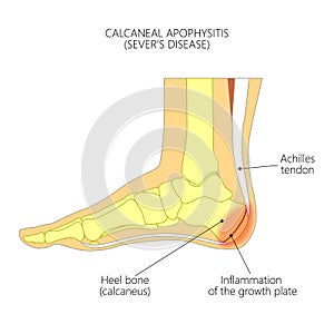 Calcaneal Apophysitis