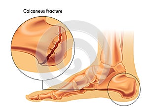 Calcaneus fracture