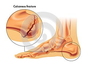 Calcaneus fracture photo