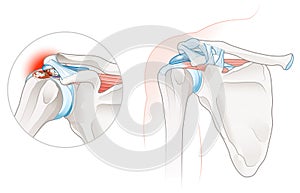 Calcific Tendinitis Shoulder Illustration. Labeled