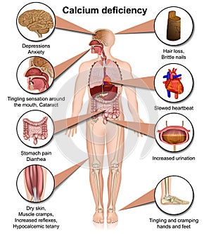 Calcium deficiency medical vector illustration isolated on white background infographic