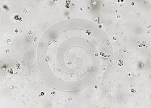 Calcium oxalate crystal in human urine