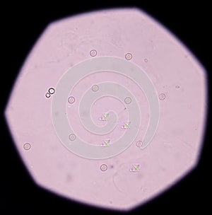 Calcium oxalate crystal in urine analysis.