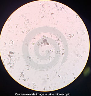 Calcium oxalate image in urine microscopic