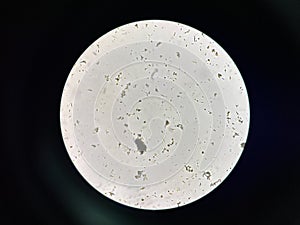 Calcium phosphate crystal in urine