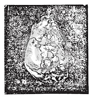 Calculation of sodium urate enchatonne in the bladder mucosa and