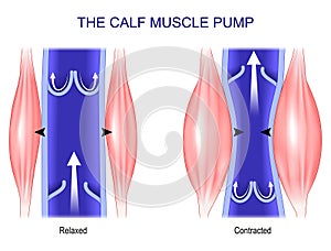 Calf muscle pump. Venous Health