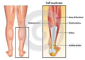 Calf muscle tear