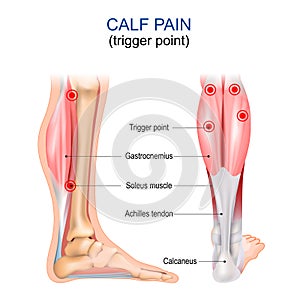 Calf pain. Trigger point. Gastrocnemius, Soleus muscle, Achilles tendon and Calcaneus photo