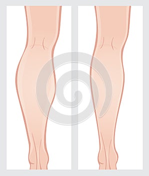 Calf reduction surgery photo