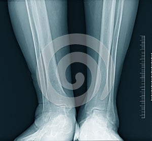 Calf x-ray