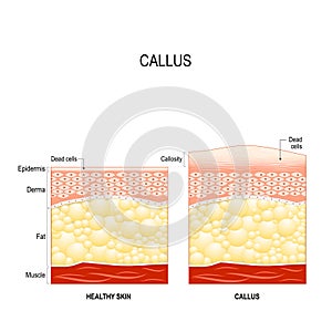 Callus. callosity