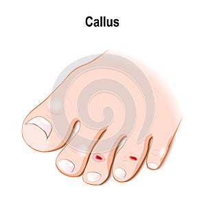 Callus or callosity