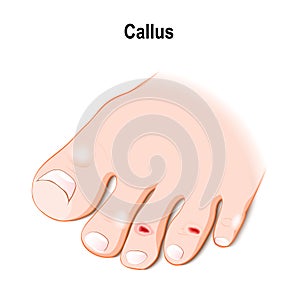 Callus or callosity photo