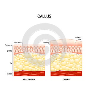 Callus. callosity photo