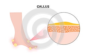 Callus and corns