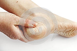 Callus and dry skin on a woman`s feet. Cornea on the heel photo