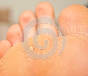 Callus and hyperkeratosis photo