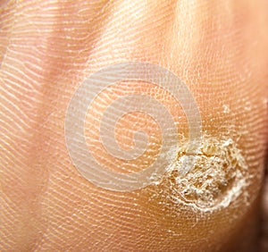 Callus and hyperkeratosis photo