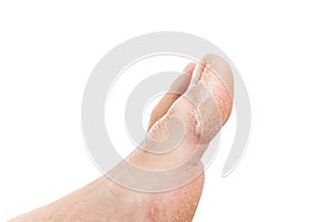 Callus problem on woman toe