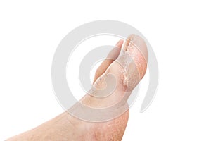 Callus problem on woman toe photo