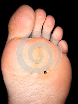 Callus under foot photo