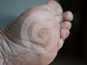 callus on a woman& x27;s foot photo