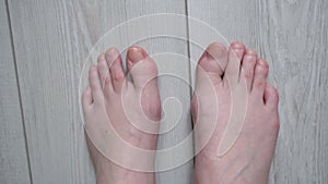Calluses on women`s feet from uncomfortable shoes. There is no pedicure.
