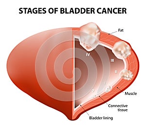 Cáncer vejiga 