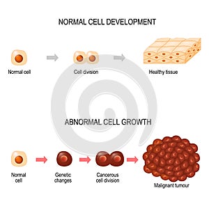 Rakovina buňka. ilustrace zobrazené rakovina nemoc rozvoj 
