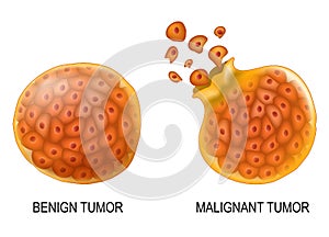 Cancer cells in Benign neoplasm and Malignant tumors