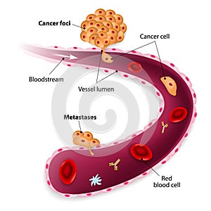 Cancer cells, cancer foci and Metastases