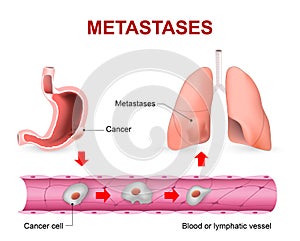 Cancer cells, cancer foci and Metastases photo