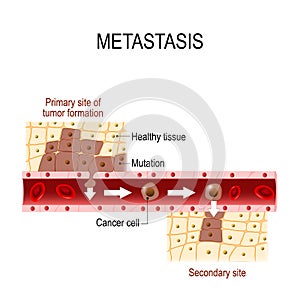 Cancer cells squeezes through blood vessel during Metastases