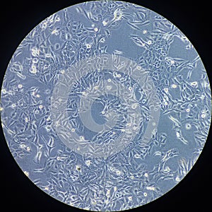 Cancer cells under microscope