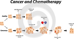 Cancer And Chemotheraphy