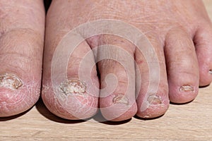 Cancer chemotherapy cause swelling of ankles . skin to become dry, dark or peel and nails brittle or flaky photo