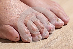 Cancer chemotherapy cause swelling of ankles (ankle oedema) , . skin to become dry, peel and nails brittle or flaky photo