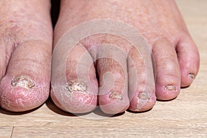 Cancer chemotherapy cause swelling of ankles . skin to become dry, dark or peel and nails brittle or flaky photo