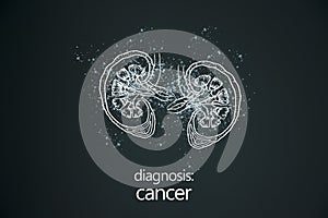 Cancer kidney disease or renal cell carcinomas. Malignant kidney tumors. photo