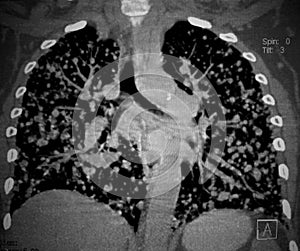 Cancer, lungs metastases. CT scan reconstruction.