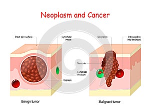 Cancer and Neoplasm. comparison and difference between Malignant and Benign tumor photo