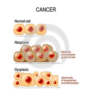 Cancer. Normal cells, Dysplasia, and Neoplasia