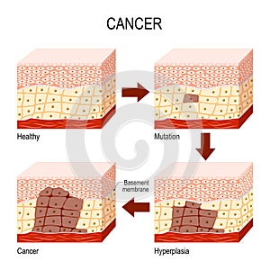 cancer. from Normal cells to Mutation, Hyperplasia, and Malignant tumor. photo