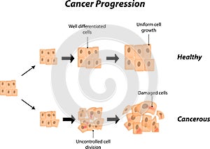 Cancer Progression