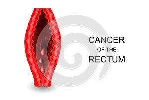 Cancer of the rectum