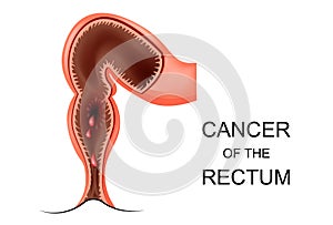Cancer of the rectum photo