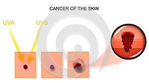 Cancer of the skin. Oncology