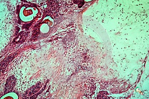 Cancer swollen Parotis diseased tissue